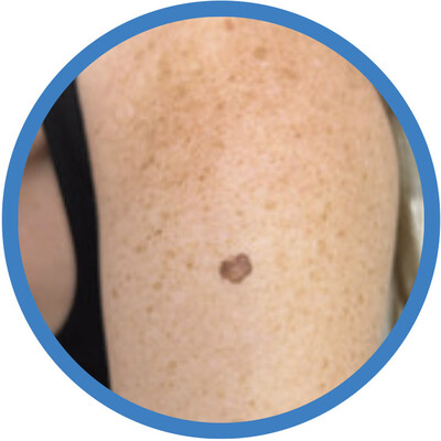 New Non-Healing Growth