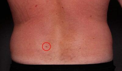 Link to: https://molepatrol.janeapp.com/#/staff_member/3/treatment/3