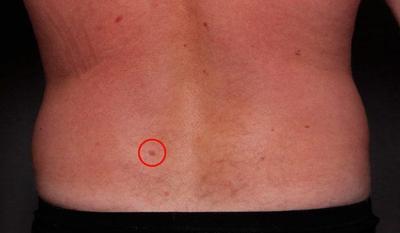 Link to: https://molepatrol.janeapp.com/#/staff_member/3/treatment/3